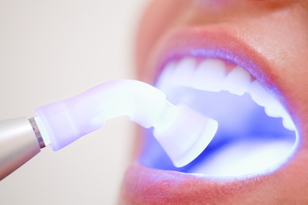 Teeth Whitening Maintenance Tips | Dr. BestPrice