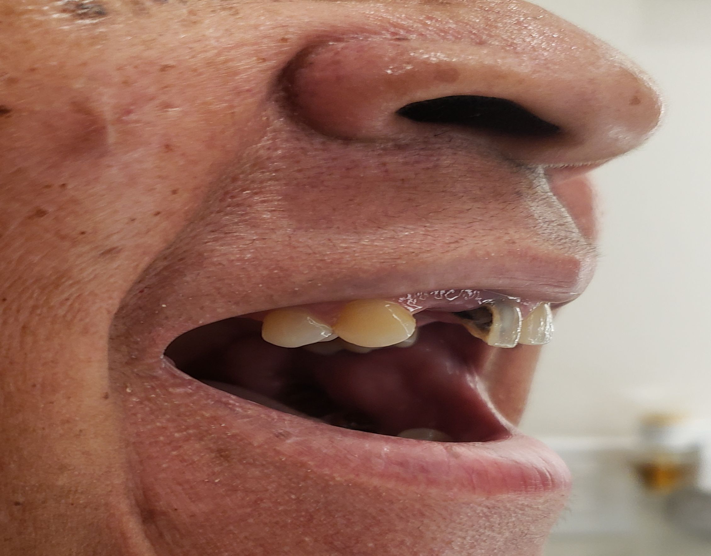 mouth right side