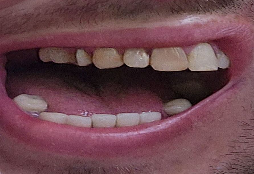 mouth right side