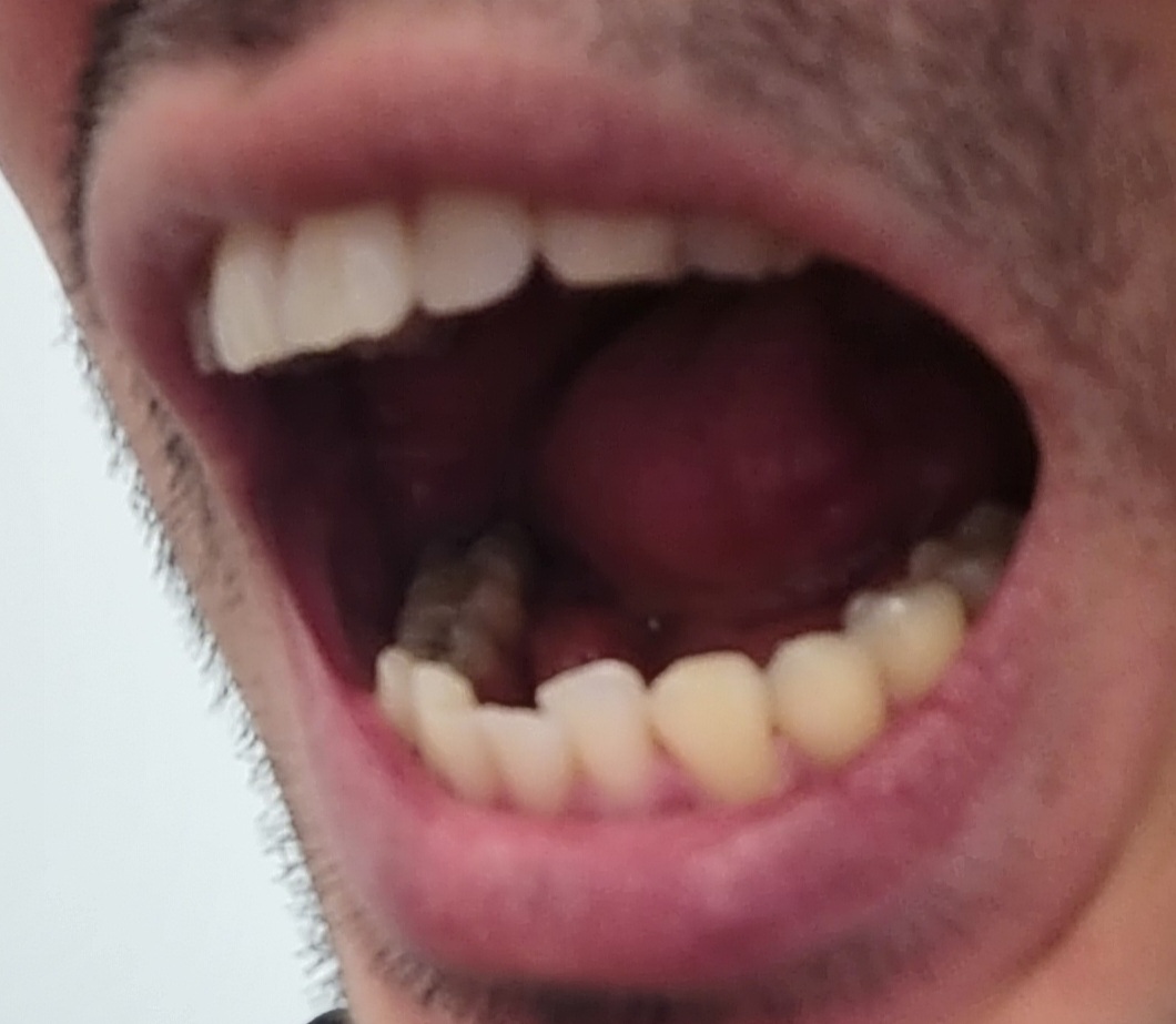 mouth right side