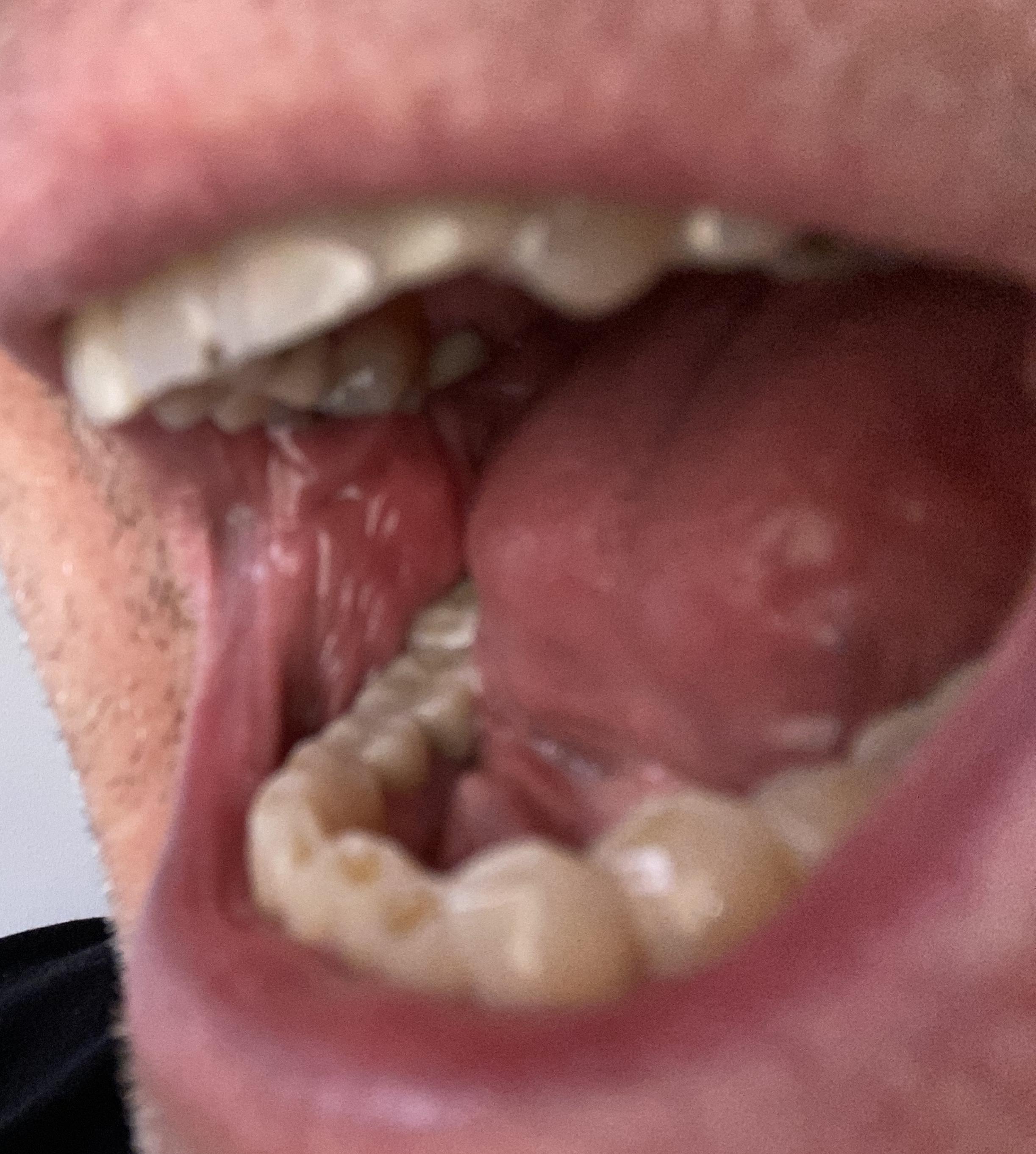 mouth left side